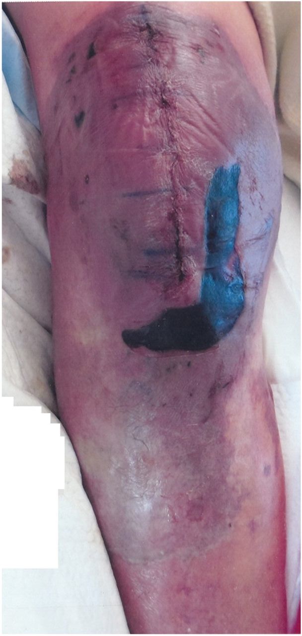 TKA Wound Complications Recon Orthobullets