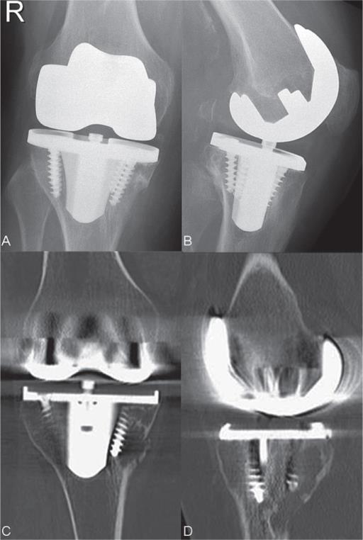 TKA Aseptic Loosening Recon Orthobullets