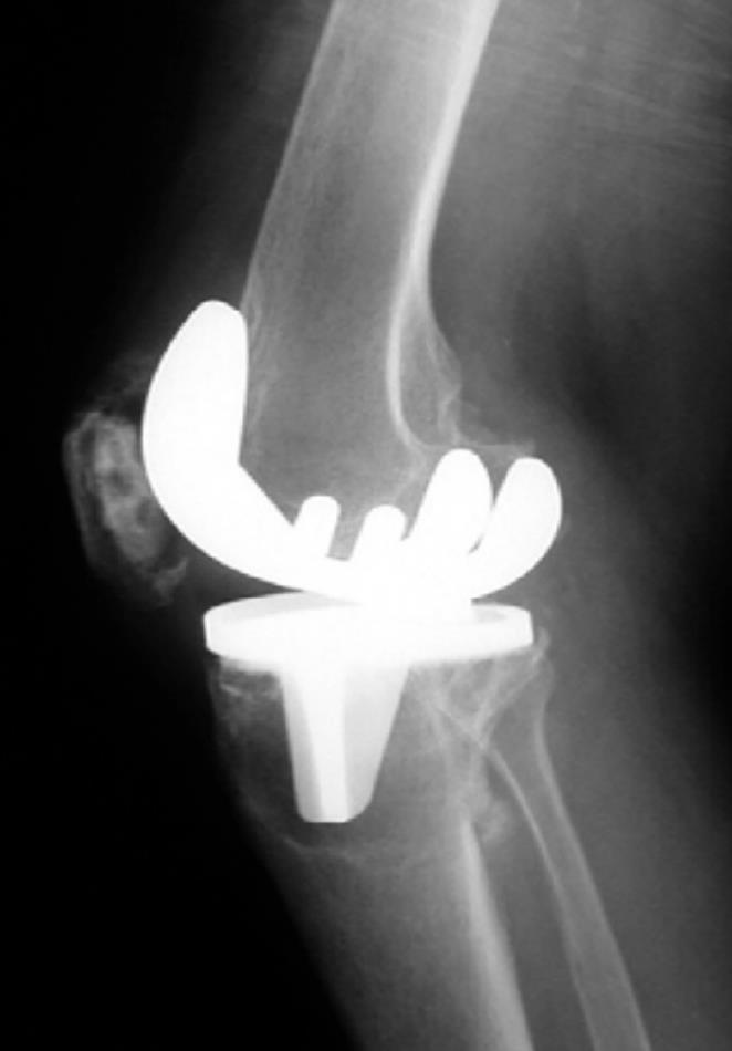 TKA Aseptic Loosening Recon Orthobullets