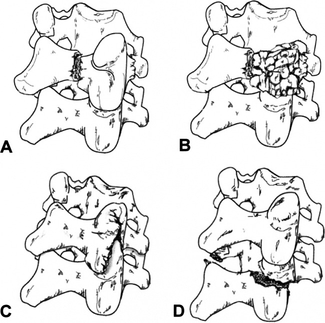 Cervical Lateral Mass Fracture Separation Spine Orthobullets