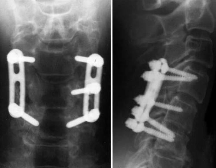 Cervical Lateral Mass Fracture Separation Spine Orthobullets