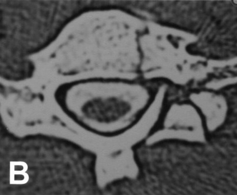 Cervical Lateral Mass Fracture Separation Spine Orthobullets