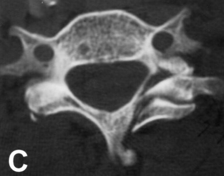 Cervical Lateral Mass Fracture Separation Spine Orthobullets