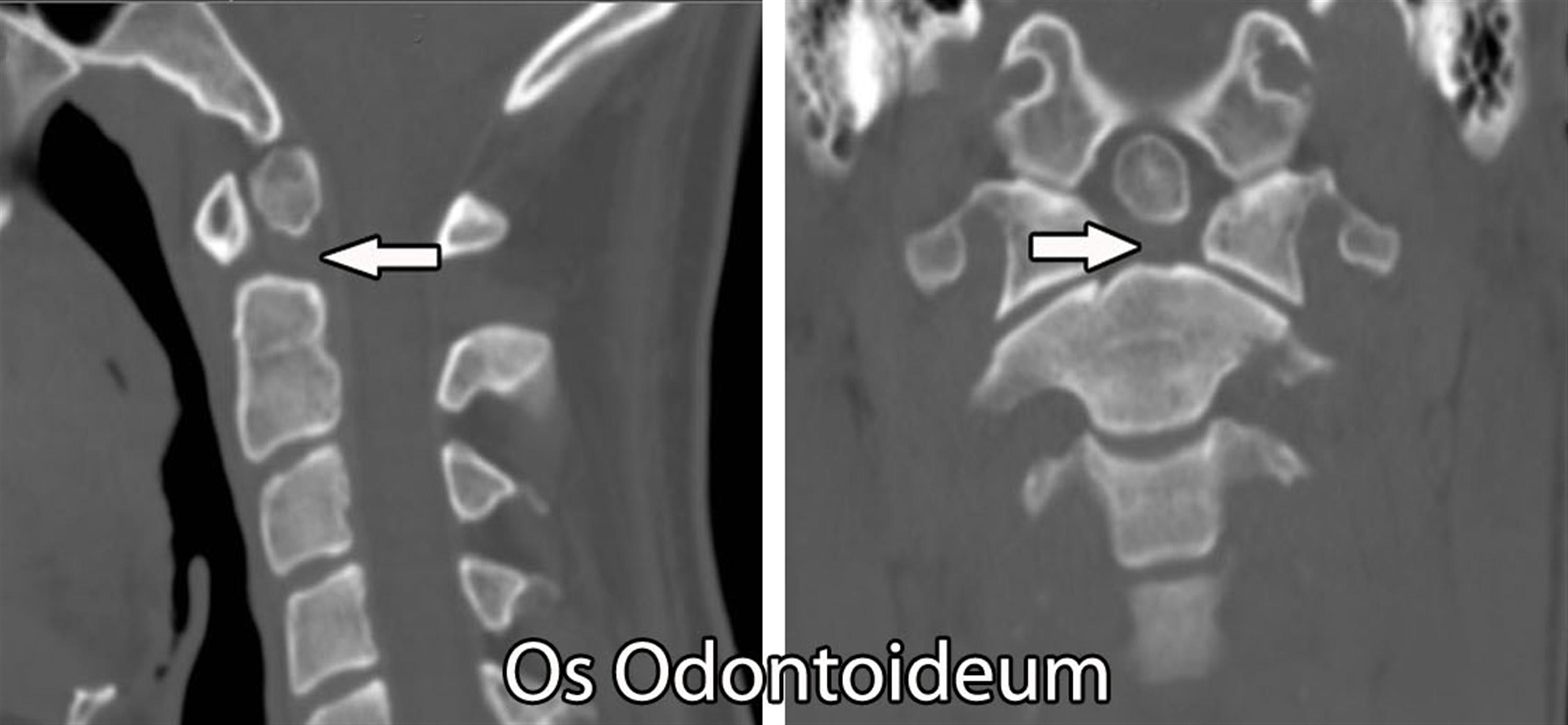 Odontoid Fracture Spine Orthobullets
