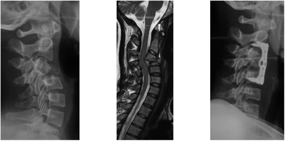 Spinal Tuberculosis Spine Orthobullets