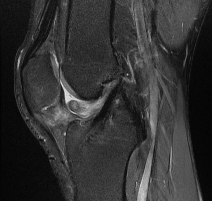 ACL Tear Knee & Sports Orthobullets