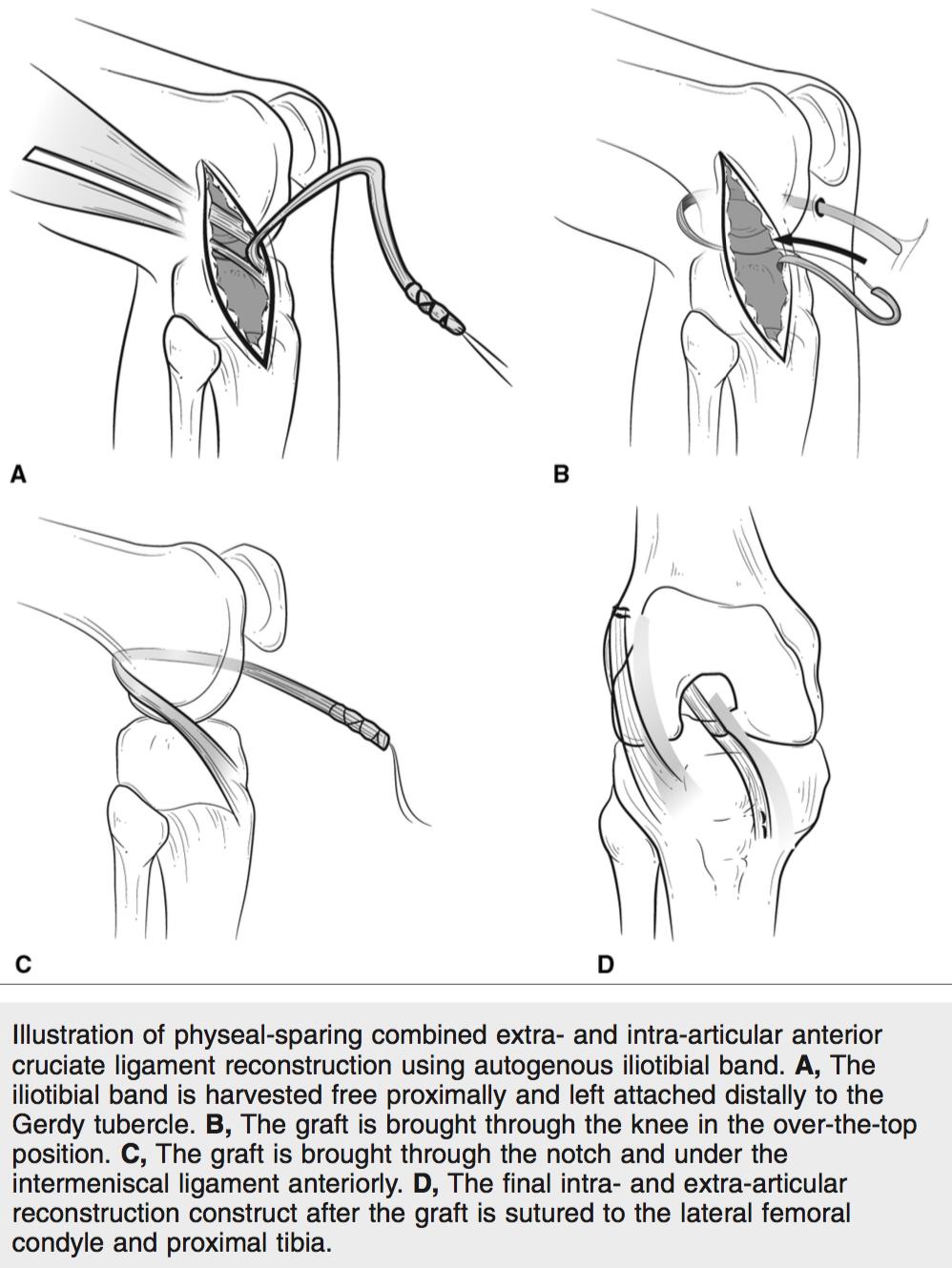 ACL Tear Knee & Sports Orthobullets