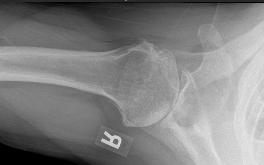 Glenohumeral Arthritis (Shoulder Arthritis) Shoulder & Elbow