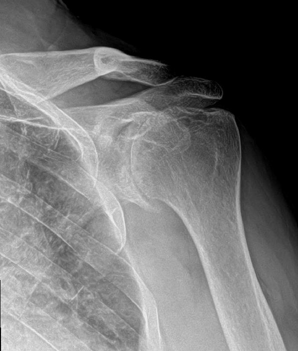Glenohumeral Arthritis (Shoulder Arthritis) Shoulder & Elbow
