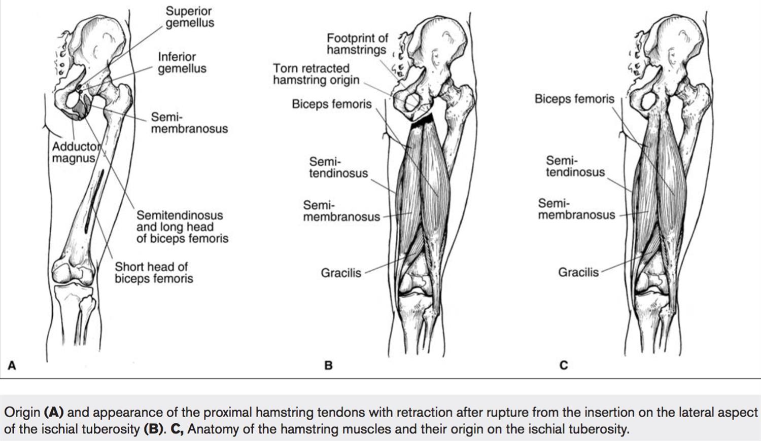 Hamstring Injuries Knee & Sports Orthobullets