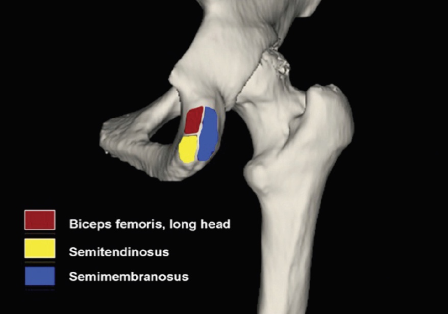 Ischial Tuberosity Bursitis