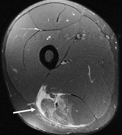 Hamstring Injuries Knee & Sports Orthobullets