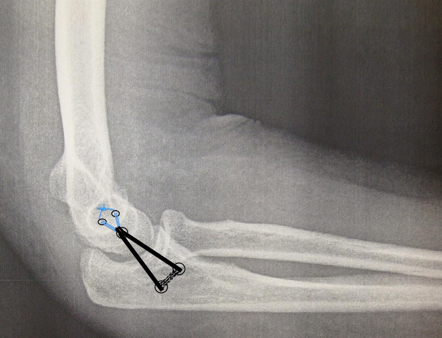 Ulnar Collateral Ligament Elbow Reconstruction