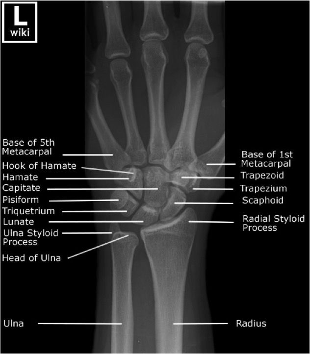 Wrist Trauma Radiographic Evaluation Hand Orthobullets