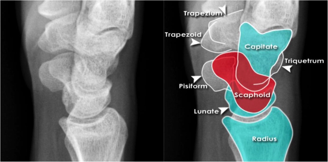 Wrist Trauma Radiographic Evaluation Hand Orthobullets