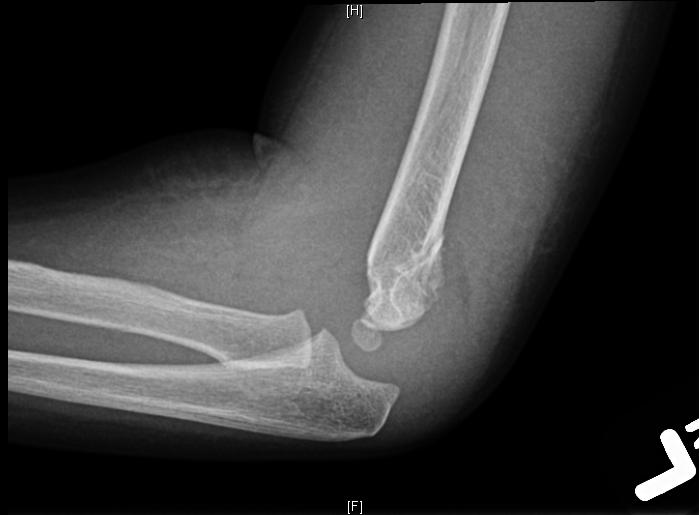 Supracondylar Fracture Pediatric Pediatrics Orthobullets