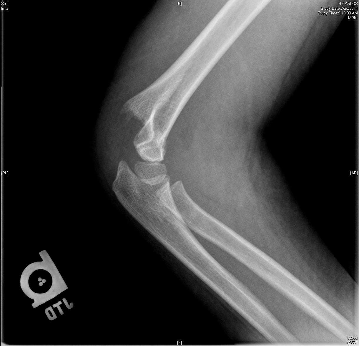 أ. د حسان النعمان Supracondylar Fracture Pediatric