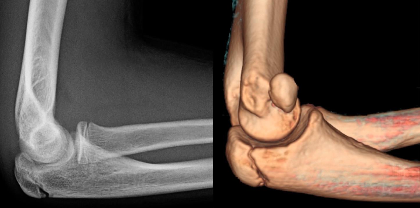 Medial Epicondylar Fractures Pediatric Pediatrics Orthobullets