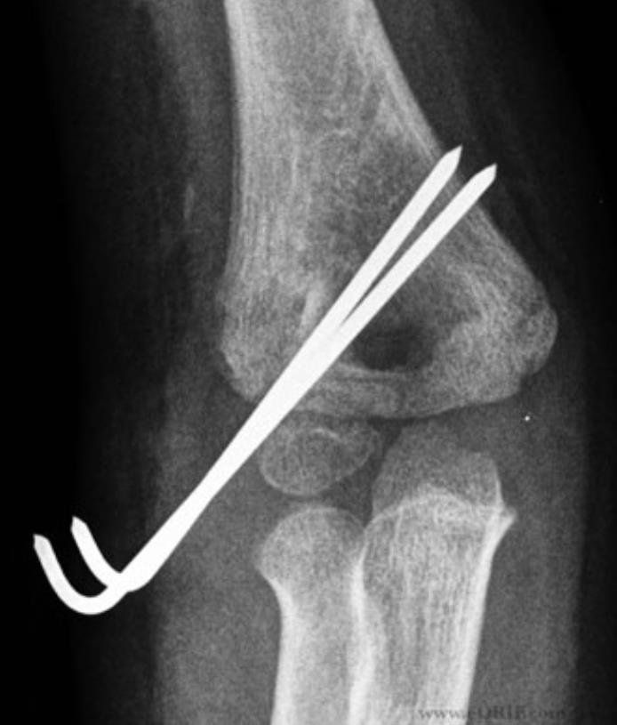 Lateral Condyle Fracture Pediatric Pediatrics Orthobullets