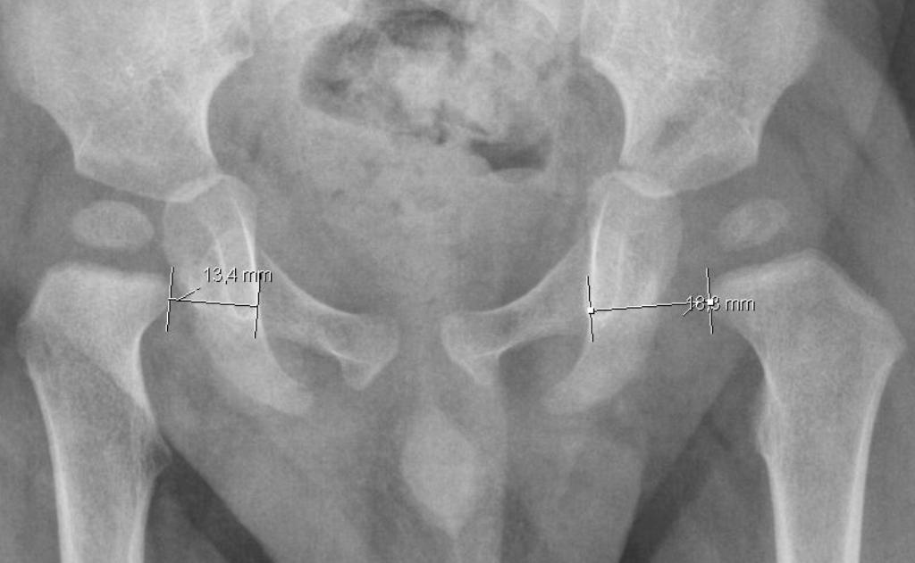 Transient Synovitis of Hip Pediatrics Orthobullets