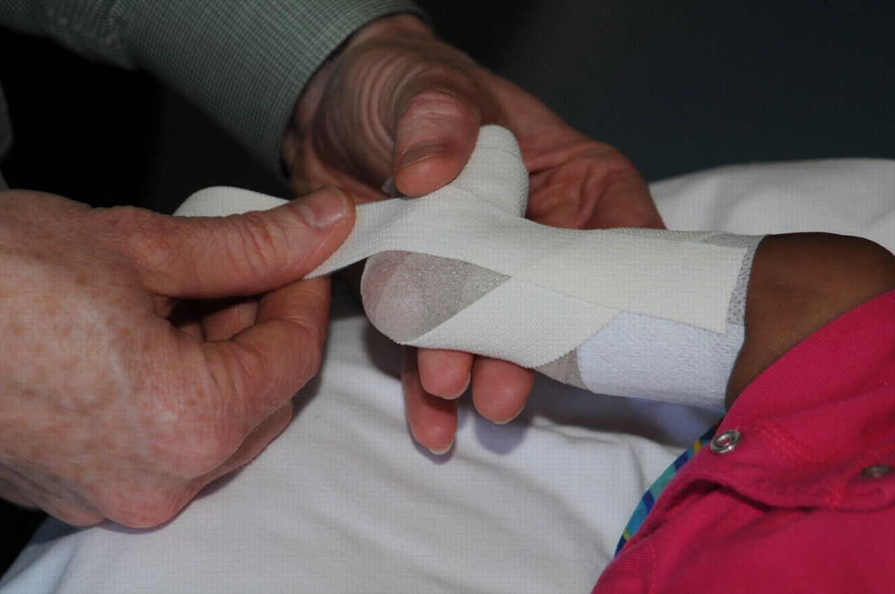 Clubfoot (congenital talipes equinovarus) Pediatrics Orthobullets