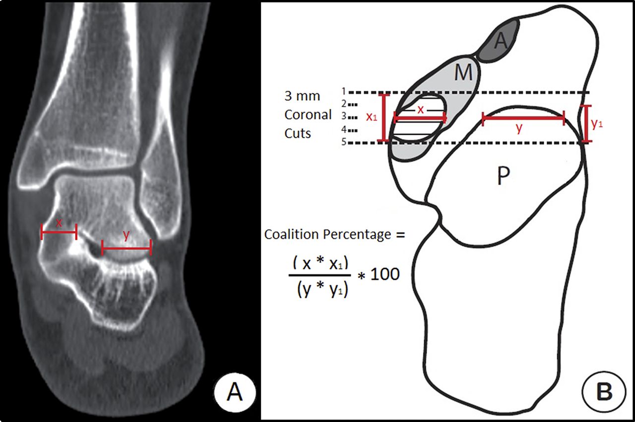 Tarsal Coalition Pediatrics Orthobullets