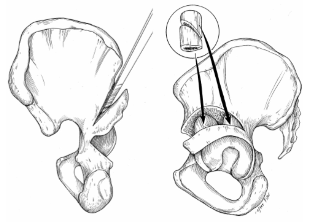 Developmental Dysplasia of the Hip (DDH) Pediatrics Orthobullets