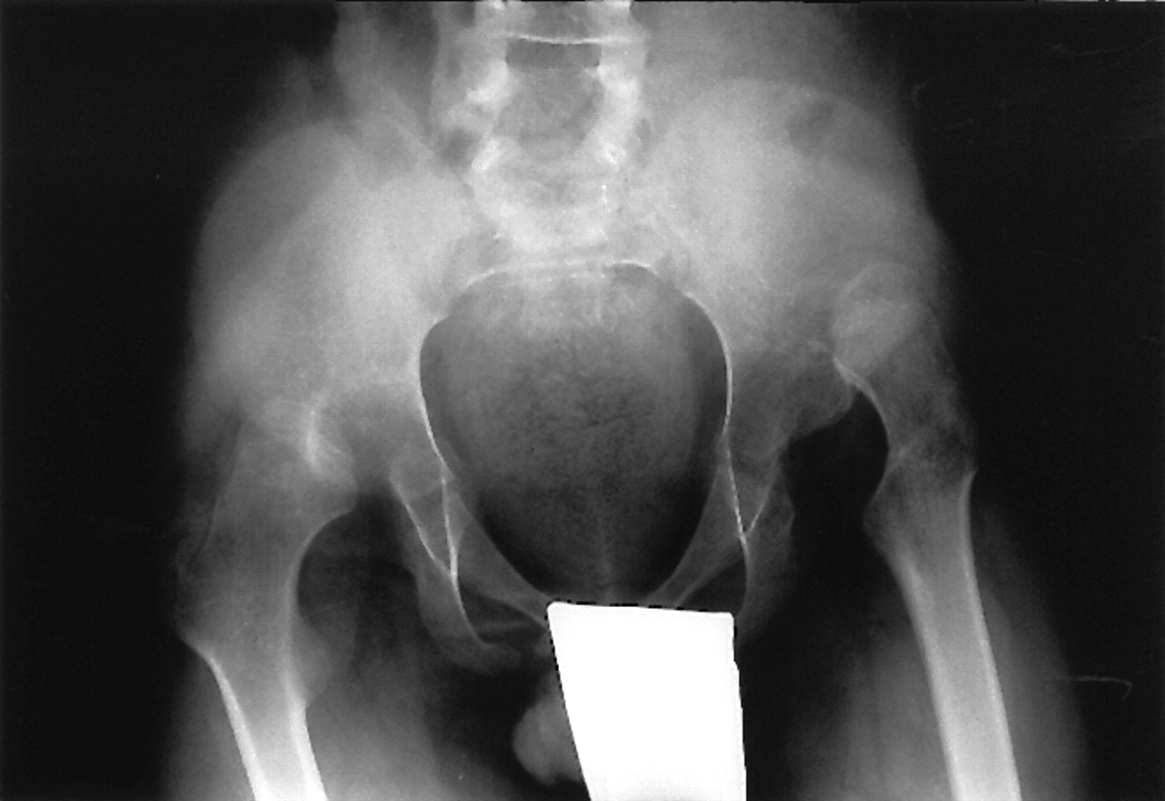 Cerebral Palsy Hip Conditions Pediatrics Orthobullets