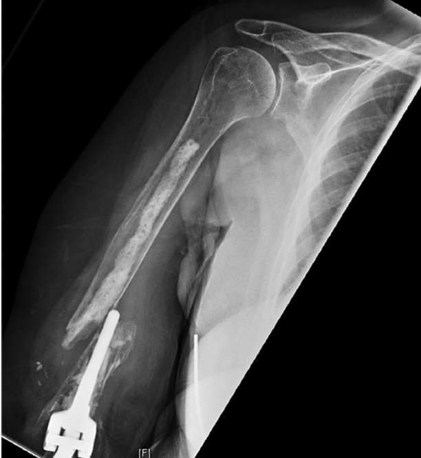 Revision Total Elbow Arthroplasty Shoulder & Elbow Orthobullets