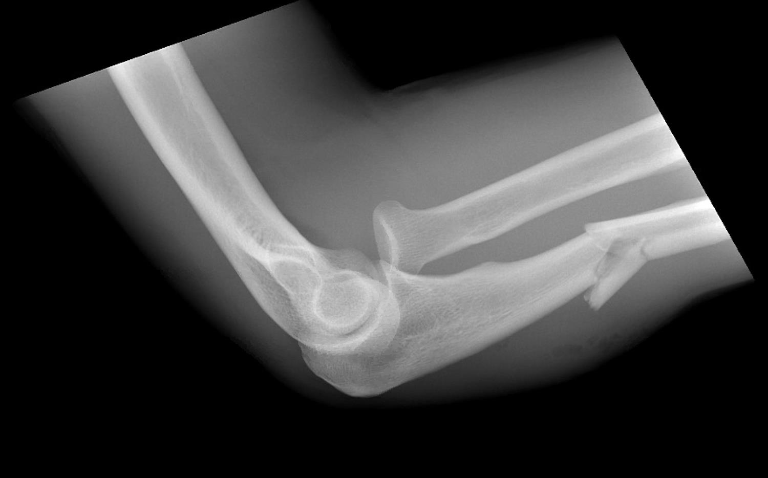 Nightstick Fracture