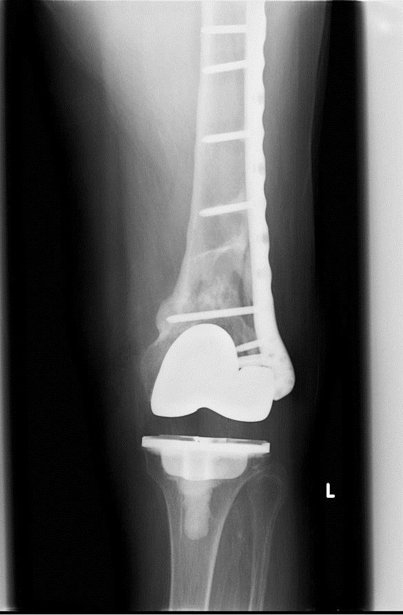 TKA Periprosthetic Fracture Recon Orthobullets