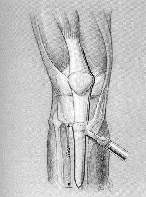 TKA Approaches Recon Orthobullets