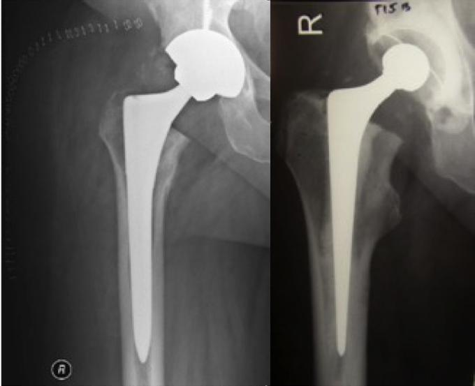 THA Prosthesis Design Recon Orthobullets