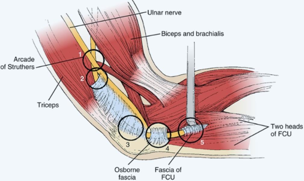 Cubital Tunnel Syndrome Icd 9 Captions Todays