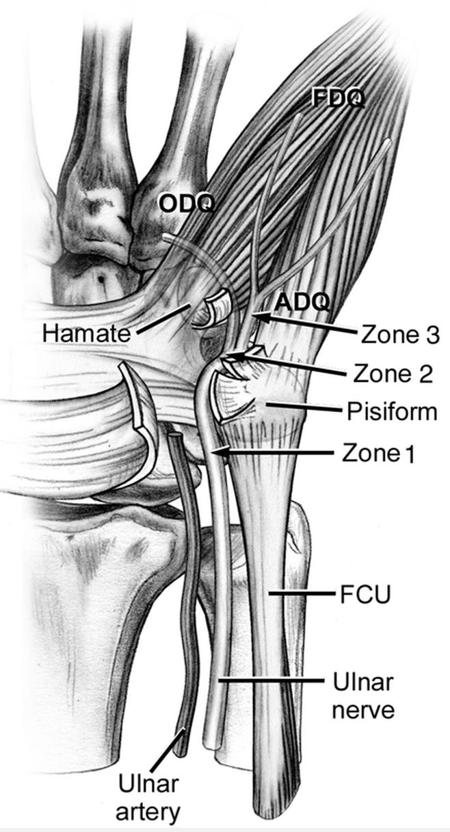 Ulnar Tunnel Syndrome Hand Orthobullets