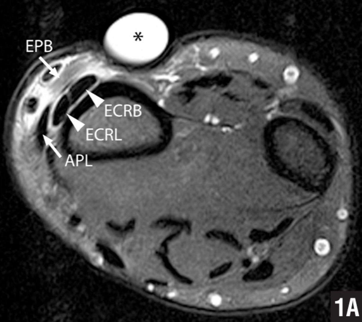 Intersection Syndrome Hand Orthobullets