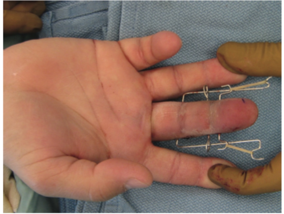 Phalanx Dislocations Hand Orthobullets