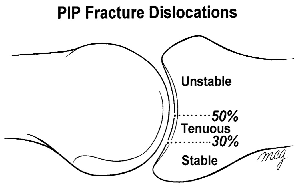 Phalanx Dislocations Hand Orthobullets