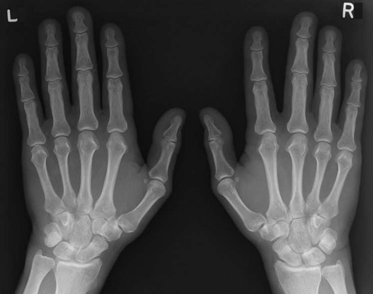 Raynaud's Syndrome Hand Orthobullets