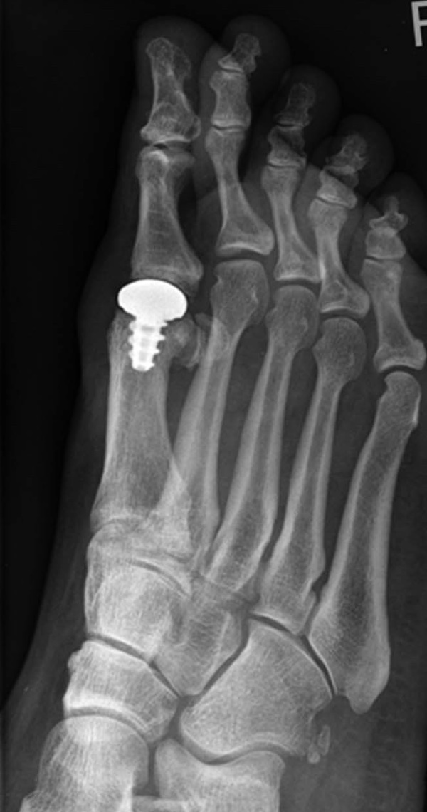 Hallux Rigidus (MTP joint arthritis) Foot & Ankle Orthobullets