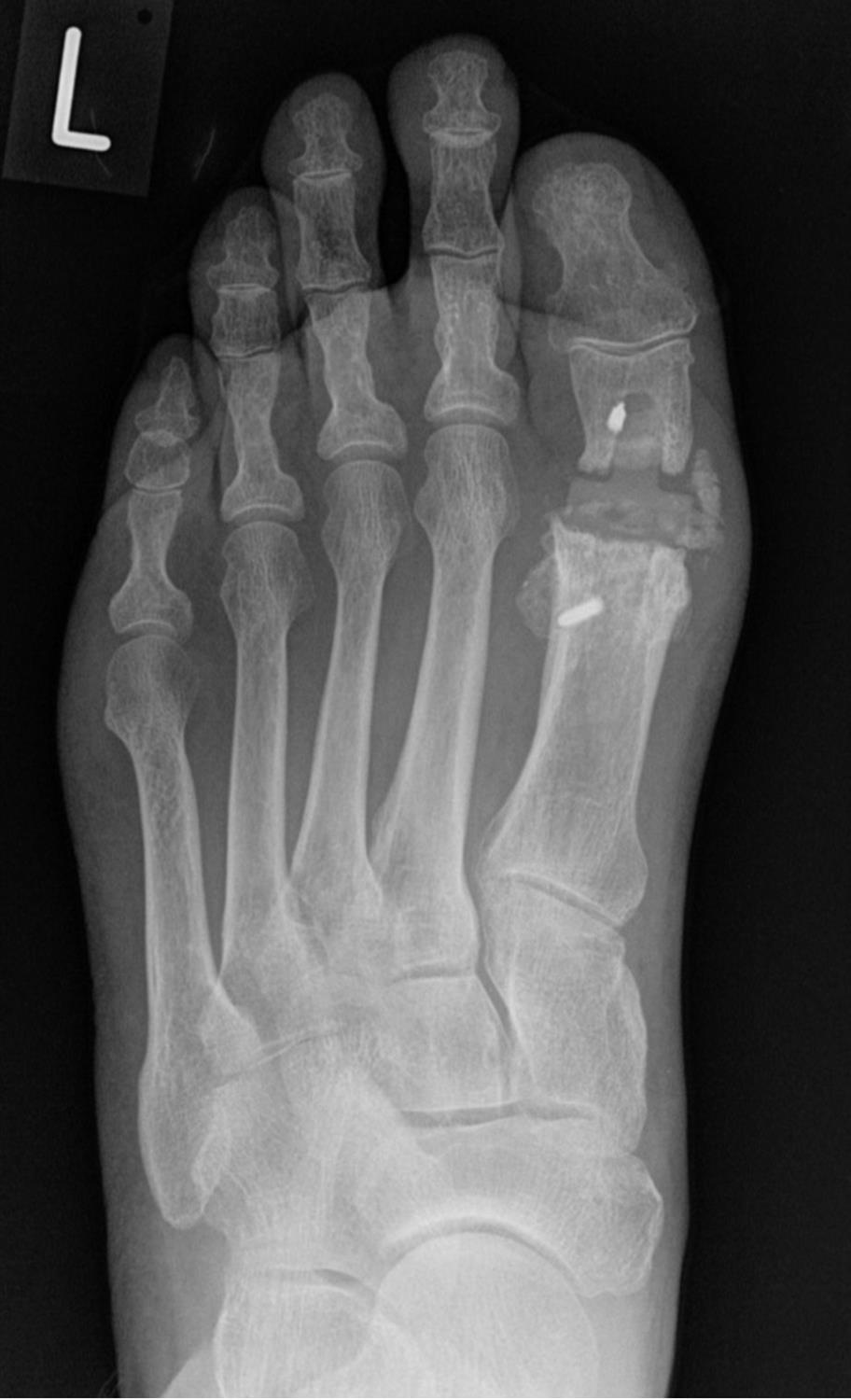 Hallux Rigidus (MTP joint arthritis) Foot & Ankle Orthobullets