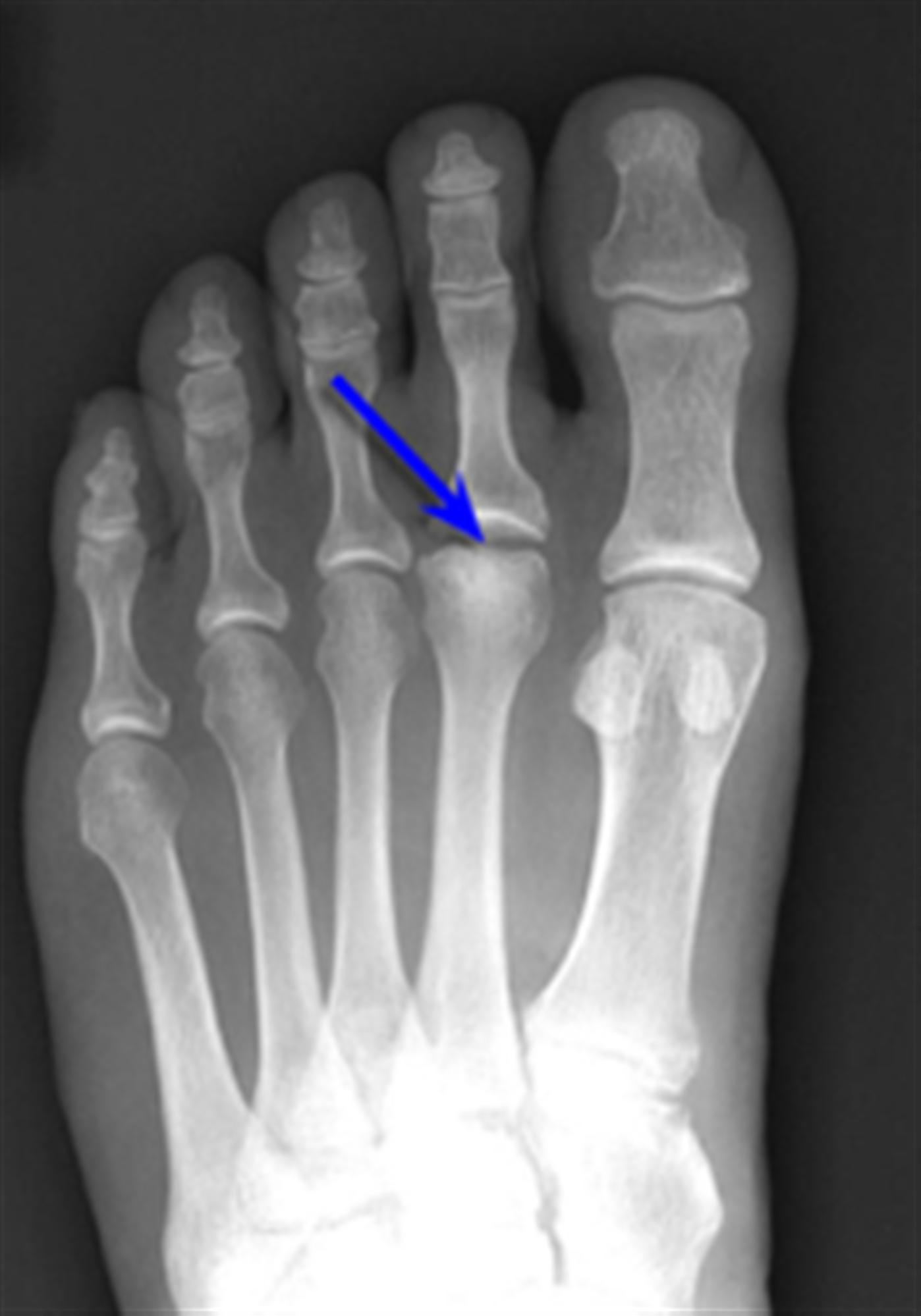Freiberg's Disease Foot & Ankle Orthobullets