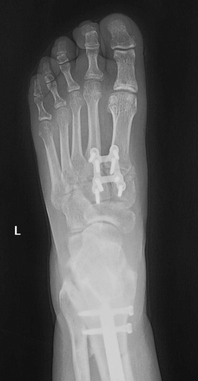 Lisfranc Injury Foot & Ankle Orthobullets