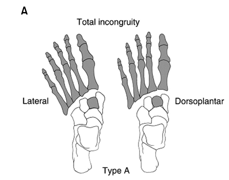 Lisfranc Injury Foot & Ankle Orthobullets