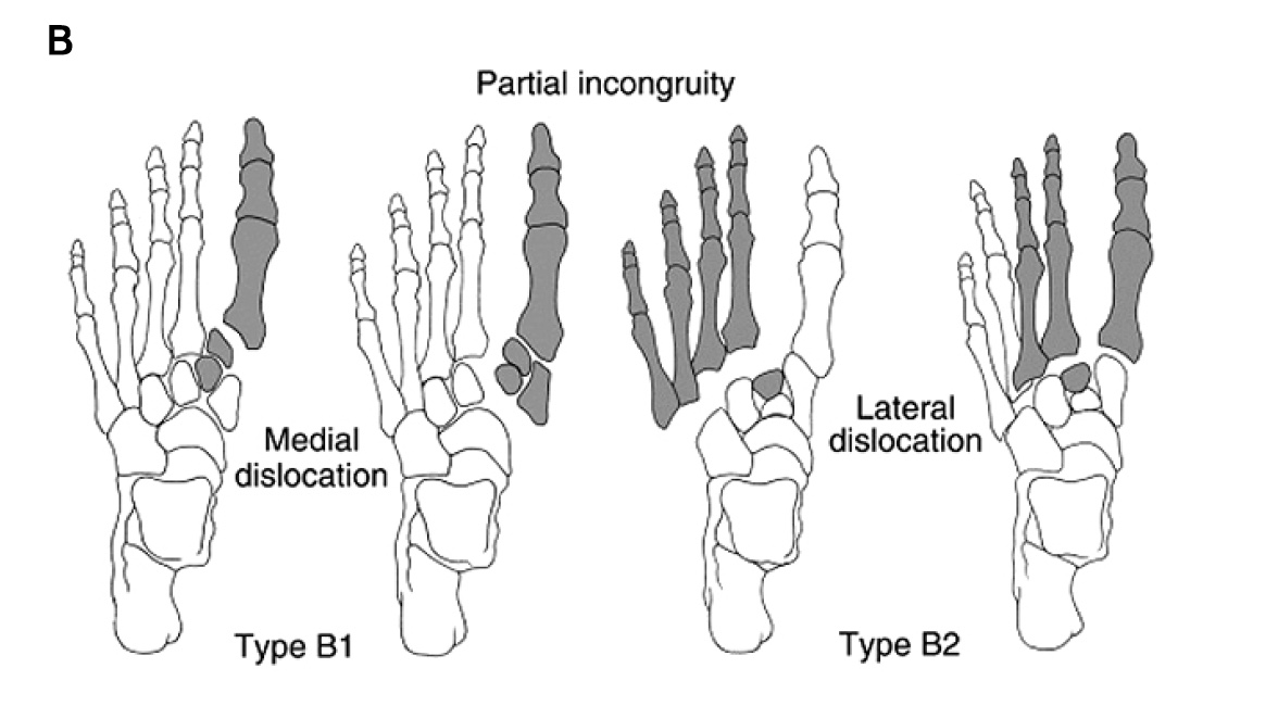 Lisfranc Injury Foot & Ankle Orthobullets