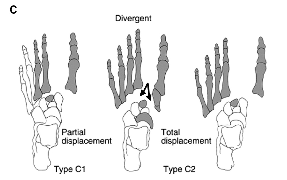 Lisfranc Injury Types