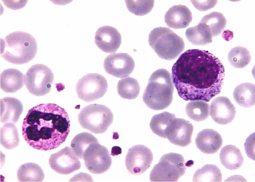 leucemia mieloide