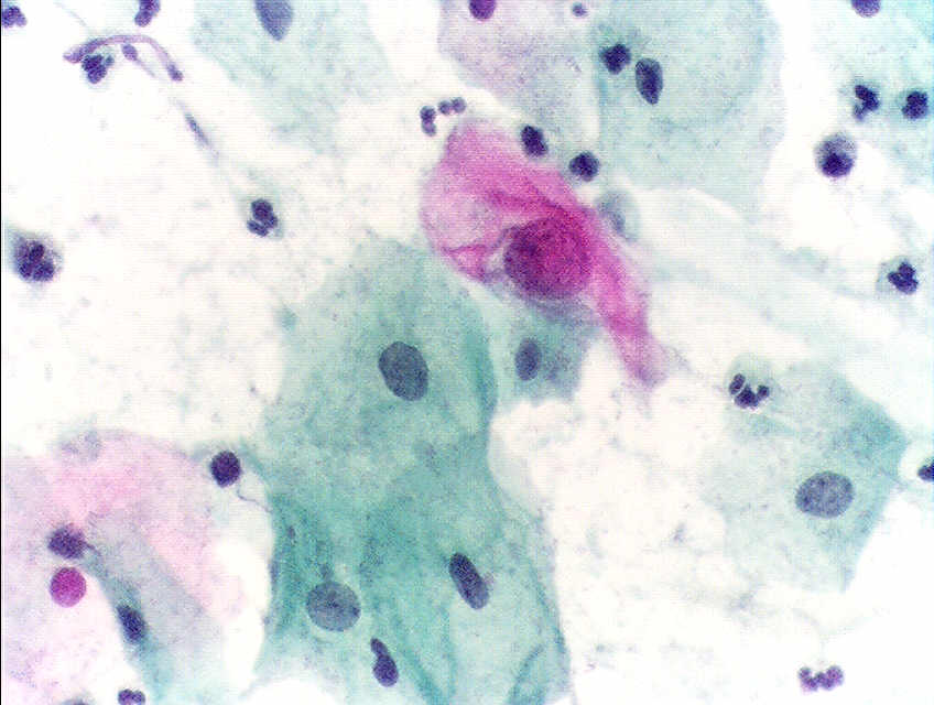 FilePap test abnormal.JPG Wikipedia