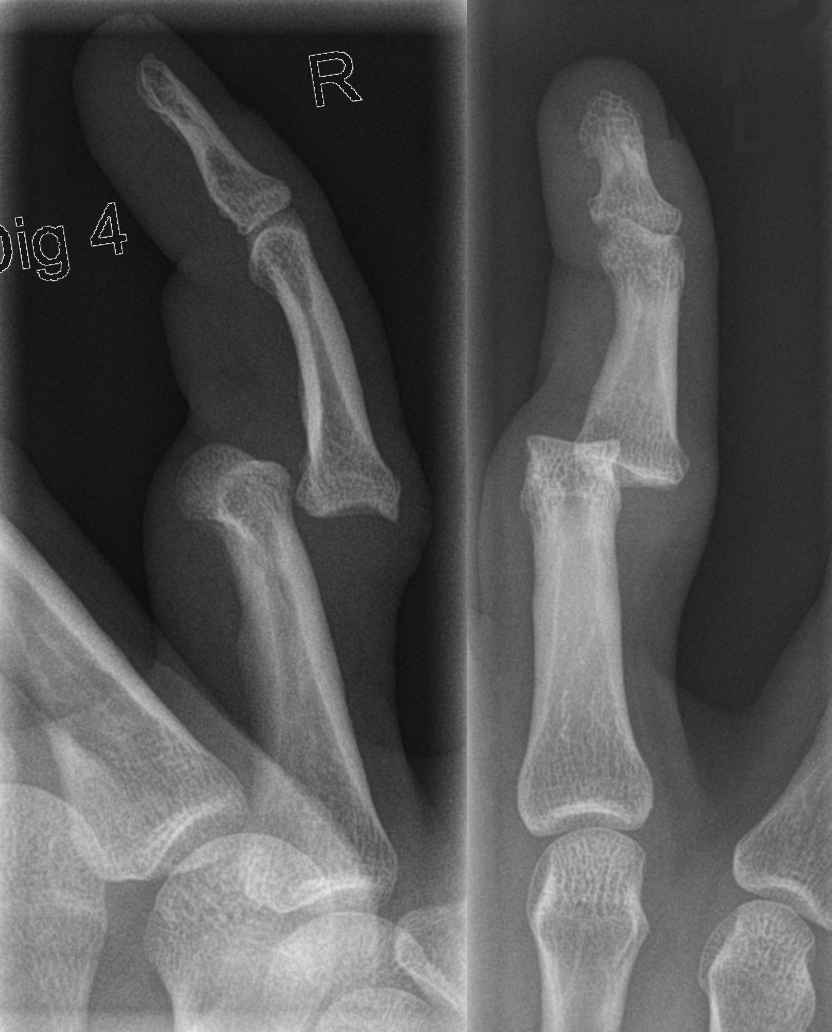 FileFinger luxation D4 PIP.png Wikimedia Commons