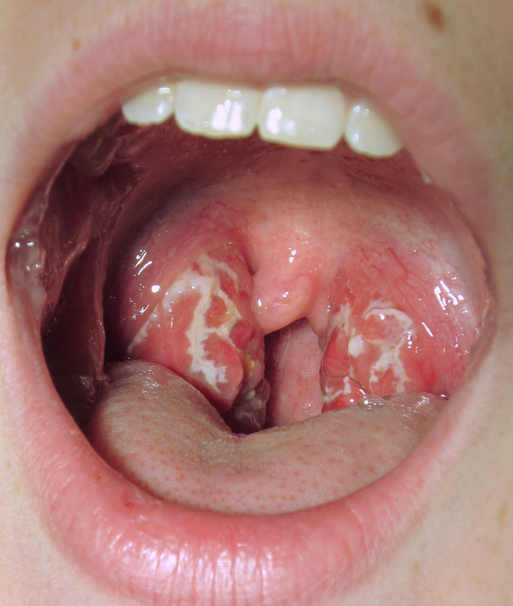 Tonsillitis - Wikipedia